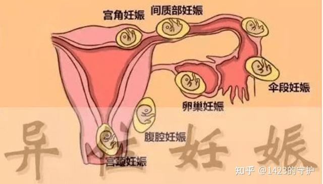 福建泉州试管移植后分泌物增多正常吗